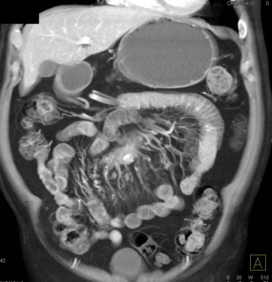 carcinoid-tumor-root-of-mesentery-with-desmoplastic-reaction-small