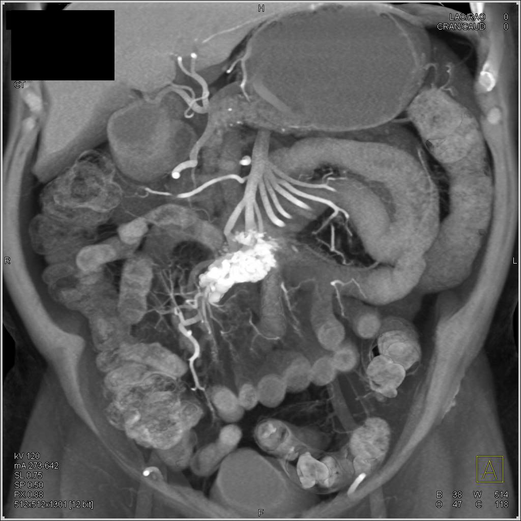 Calcified Carcinoid Tumor in the Root of the Mesentery - CTisus CT Scan