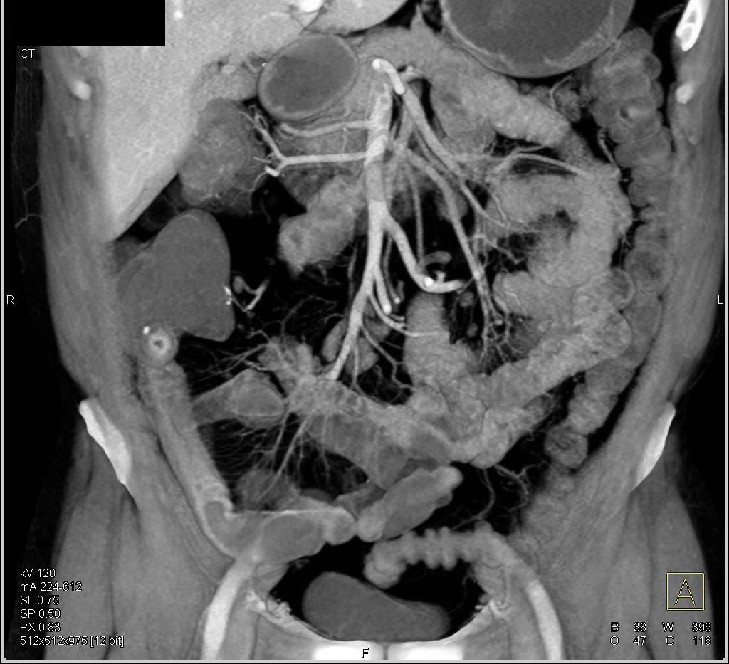 Crohn's Disease Terminal Ileum with Comb Sign - CTisus CT Scan