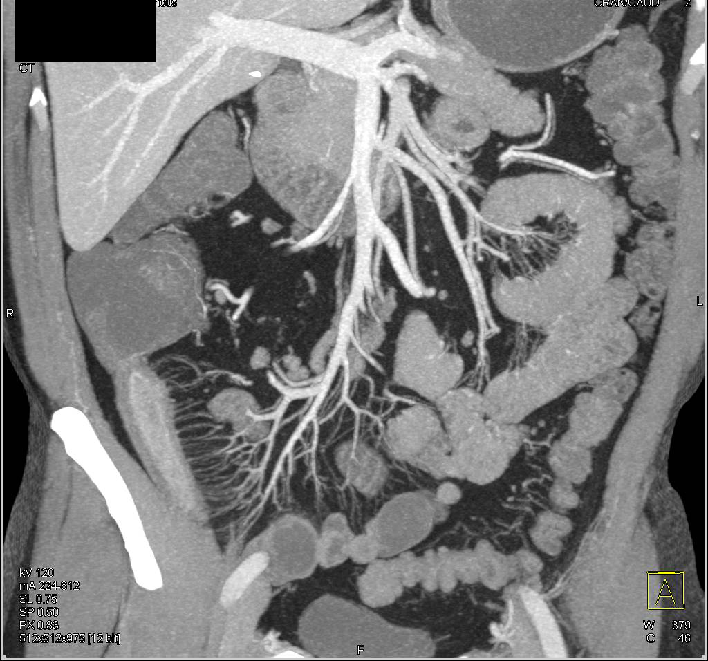 Crohn's Disease Ileum with Comb Sign with Prominent Vasa Recta - CTisus CT Scan