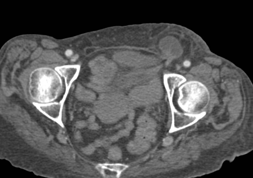 Left Inguinal Hernia is Incarcerated. - CTisus CT Scan