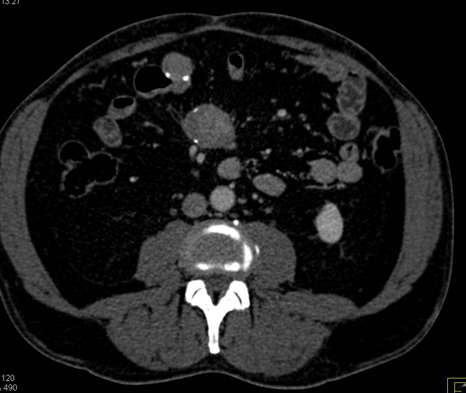 Carcinoid Tumor Root of Mesentery with Desmoplastic Reaction and Carcinoma (Likely Desmoid) - CTisus CT Scan