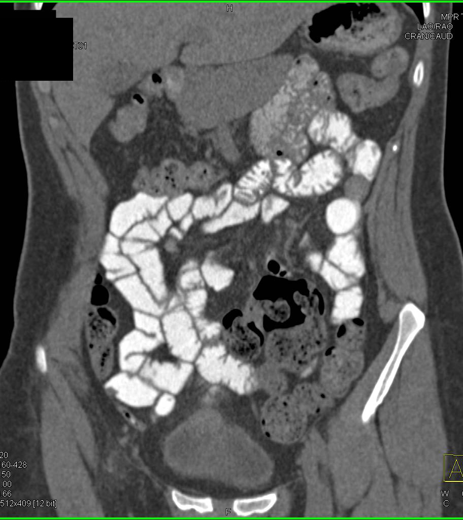 Normal Small Bowel with Positive Contrast - CTisus CT Scan