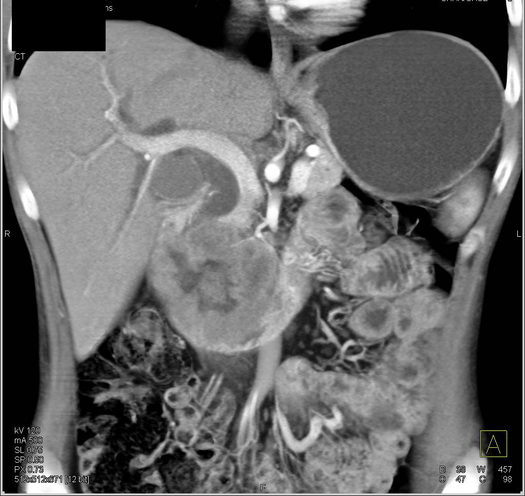 Duodenal Adenocarcinoma Obstructs the Common Bile Duct and Simulates a Pancreatic Cancer - CTisus CT Scan