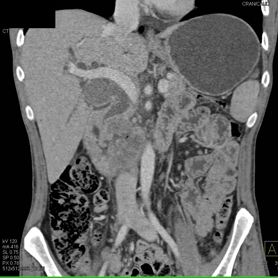 Duodenal Carcinoma Obstructs the Common Bile Duct and Simulates a Pancreatic Cancer - CTisus CT Scan