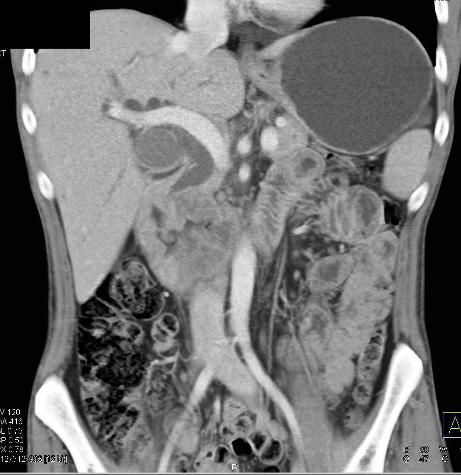 Duodenal Carcinoma Obstructs the Common Bile Duct and Simulates a Pancreatic Cancer - CTisus CT Scan