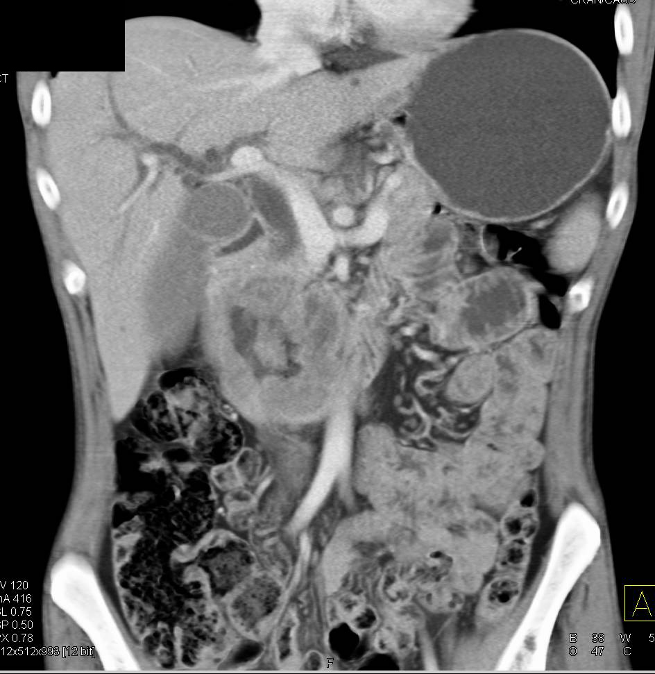 Duodenal Adenocarcinoma Simulates a Pancreatic Cancer - CTisus CT Scan