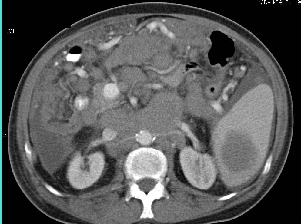 Carcinomatosis with Splenic Lesions and 2 Sets of Scans Showing Progression - CTisus CT Scan