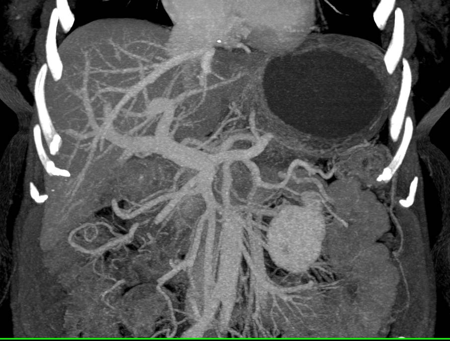 Ulcerating Duodenal Carcinoma - CTisus CT Scan