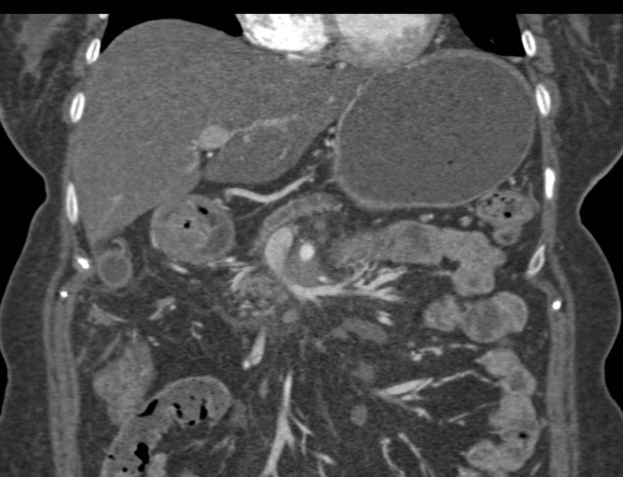 Duodenal Carcinoma - CTisus CT Scan