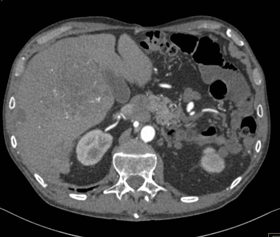 GIST Tumor with Liver Metastases - CTisus CT Scan
