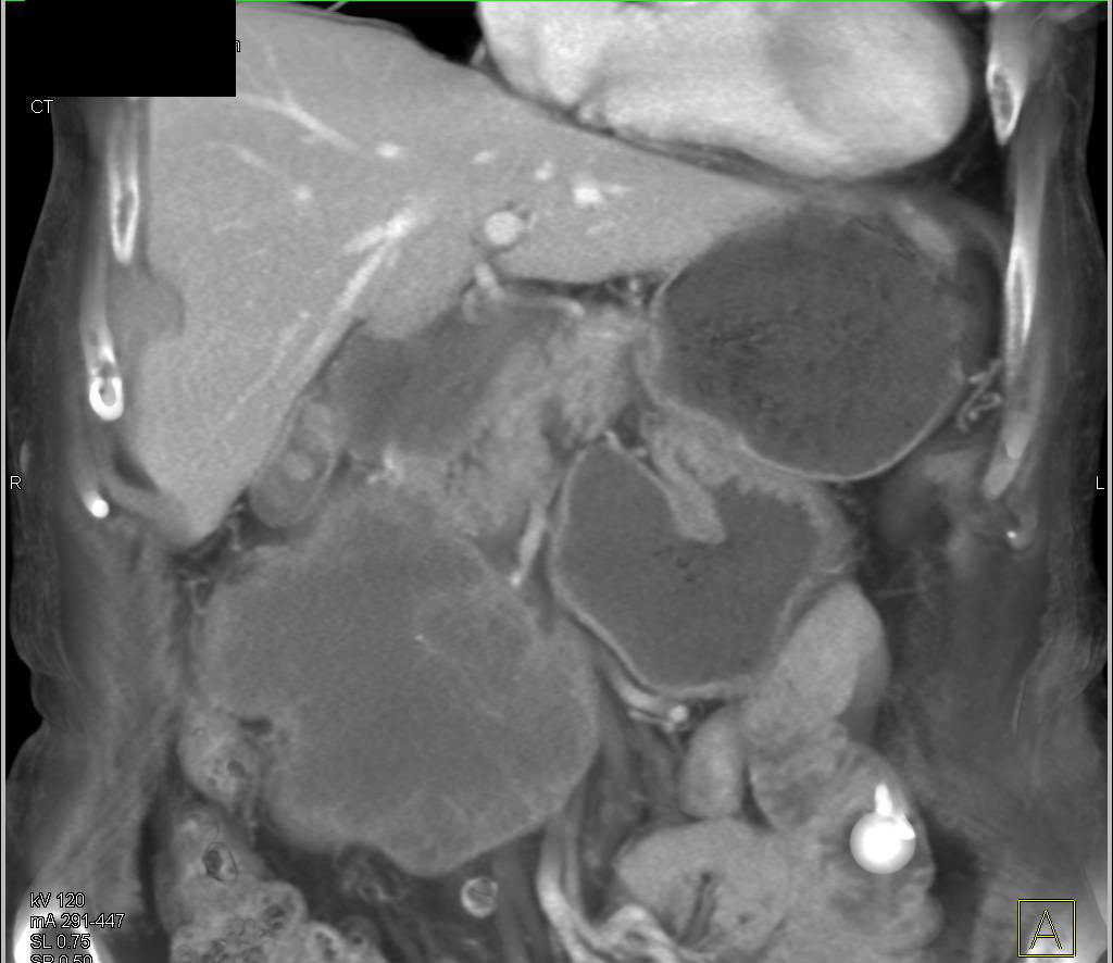 Duodenal GIST Tumor - CTisus CT Scan