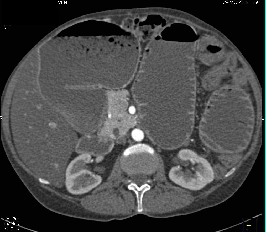 Small Bowel Obstruction due to Crohn's Disease - CTisus CT Scan
