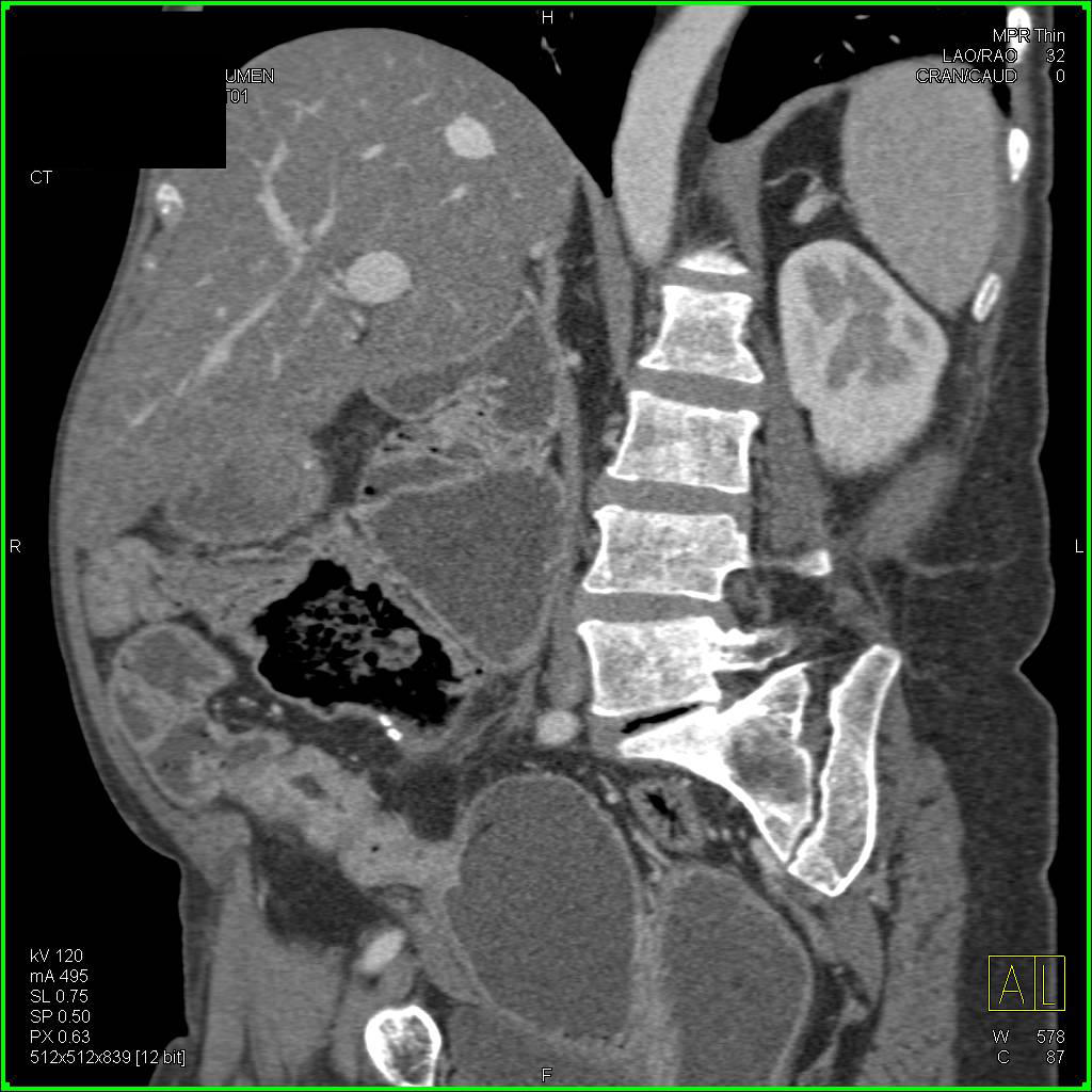 Crohn's Disease with Small Bowel Obstruction - CTisus CT Scan