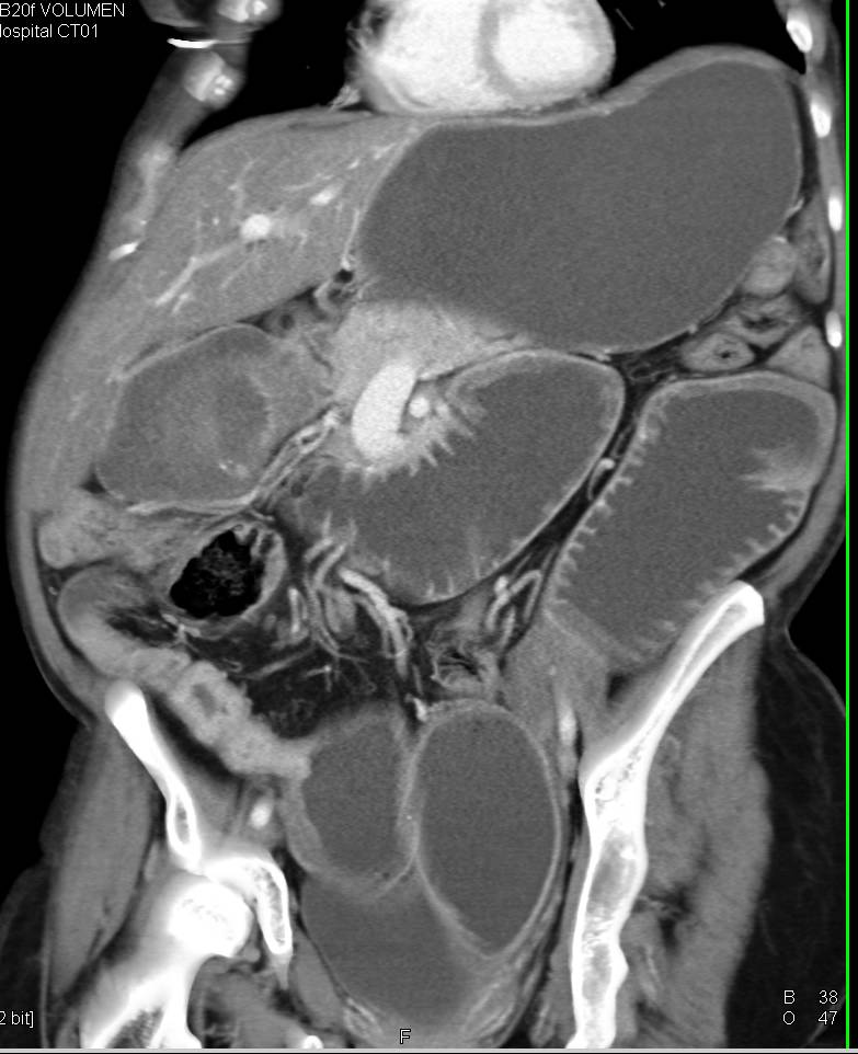 Crohn's Disease with Thickened Ileum and Small Bowel Obstruction - CTisus CT Scan