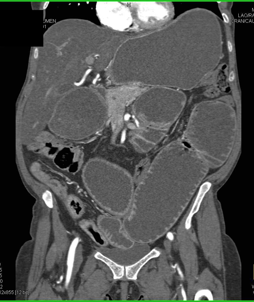 Dilated Small Bowel due to Stenotic Distal Small Bowel due to Crohn's Disease - CTisus CT Scan