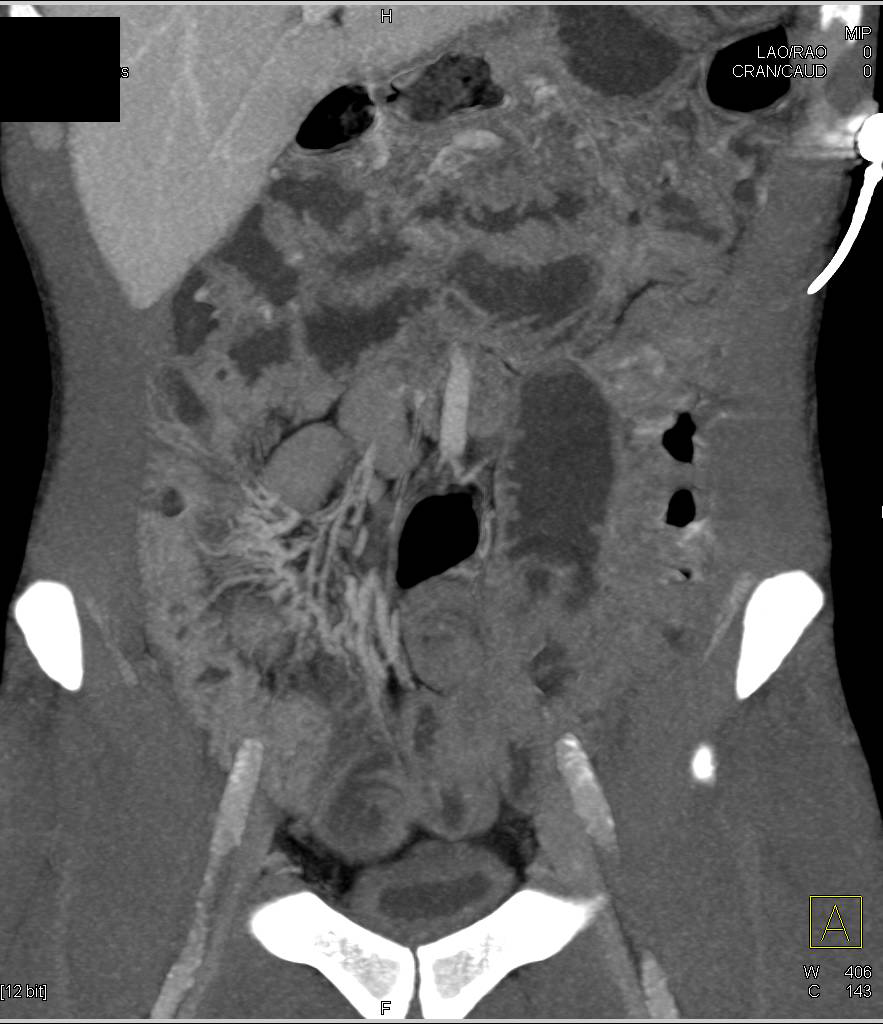 Active Crohn's Disease in Ileum - CTisus CT Scan