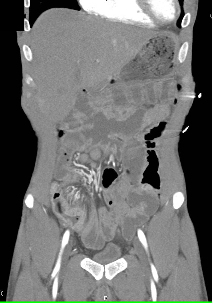 Crohn's Disease Involves Ileum with Prominent Vasa Recta - CTisus CT Scan