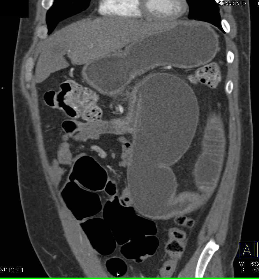 Small Bowel Obstruction (SBO) due to Crohn's Disease with Narrowed Bowel Lumen Nicely Shown in 3D - CTisus CT Scan