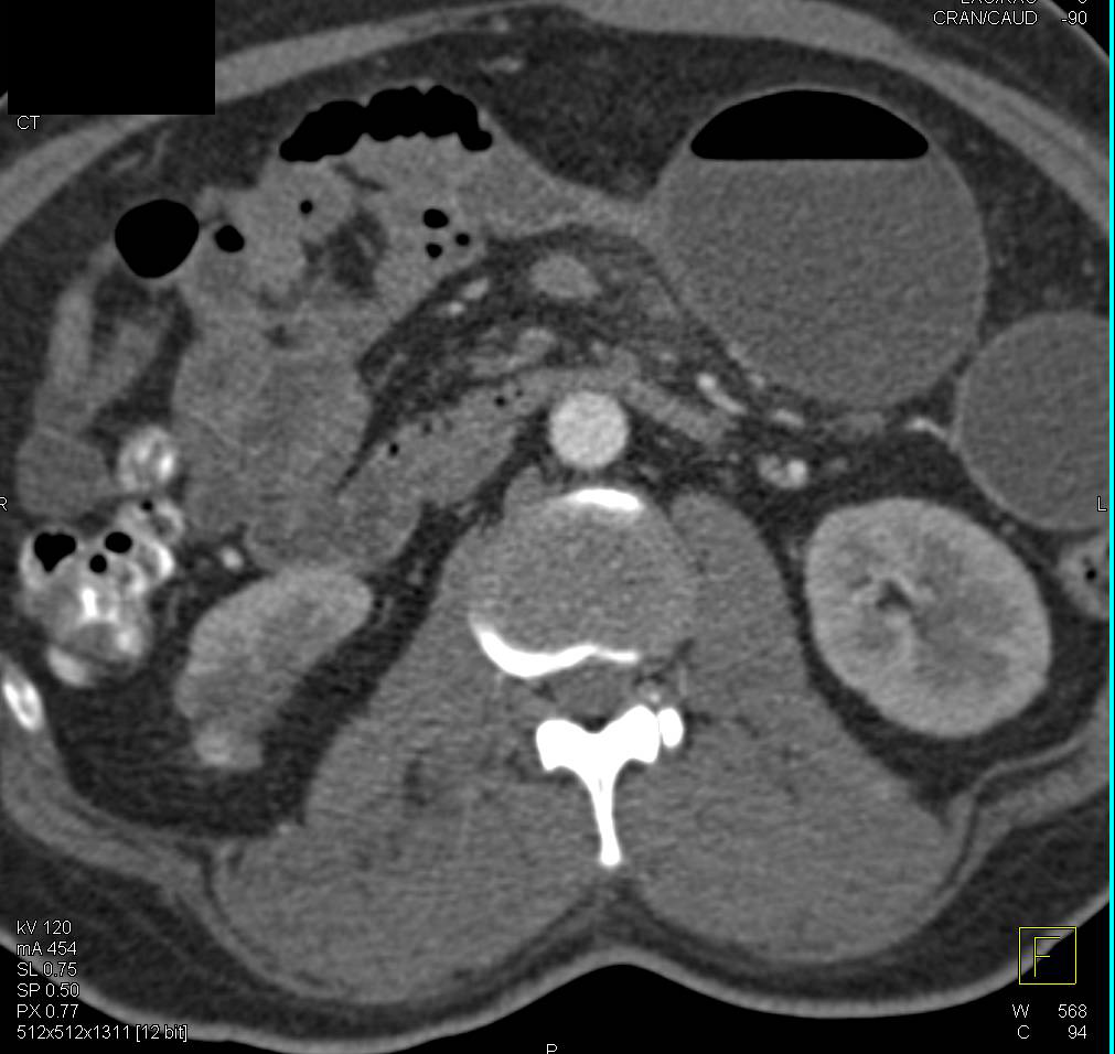 Crohn's Disease with Strictures - CTisus CT Scan