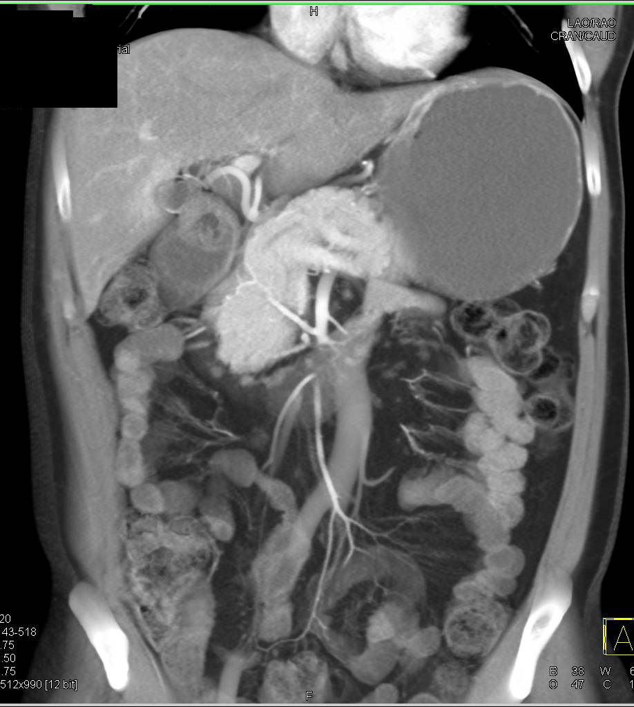 Intraluminal Duodenal Diverticulum Simulates a Mass - CTisus CT Scan