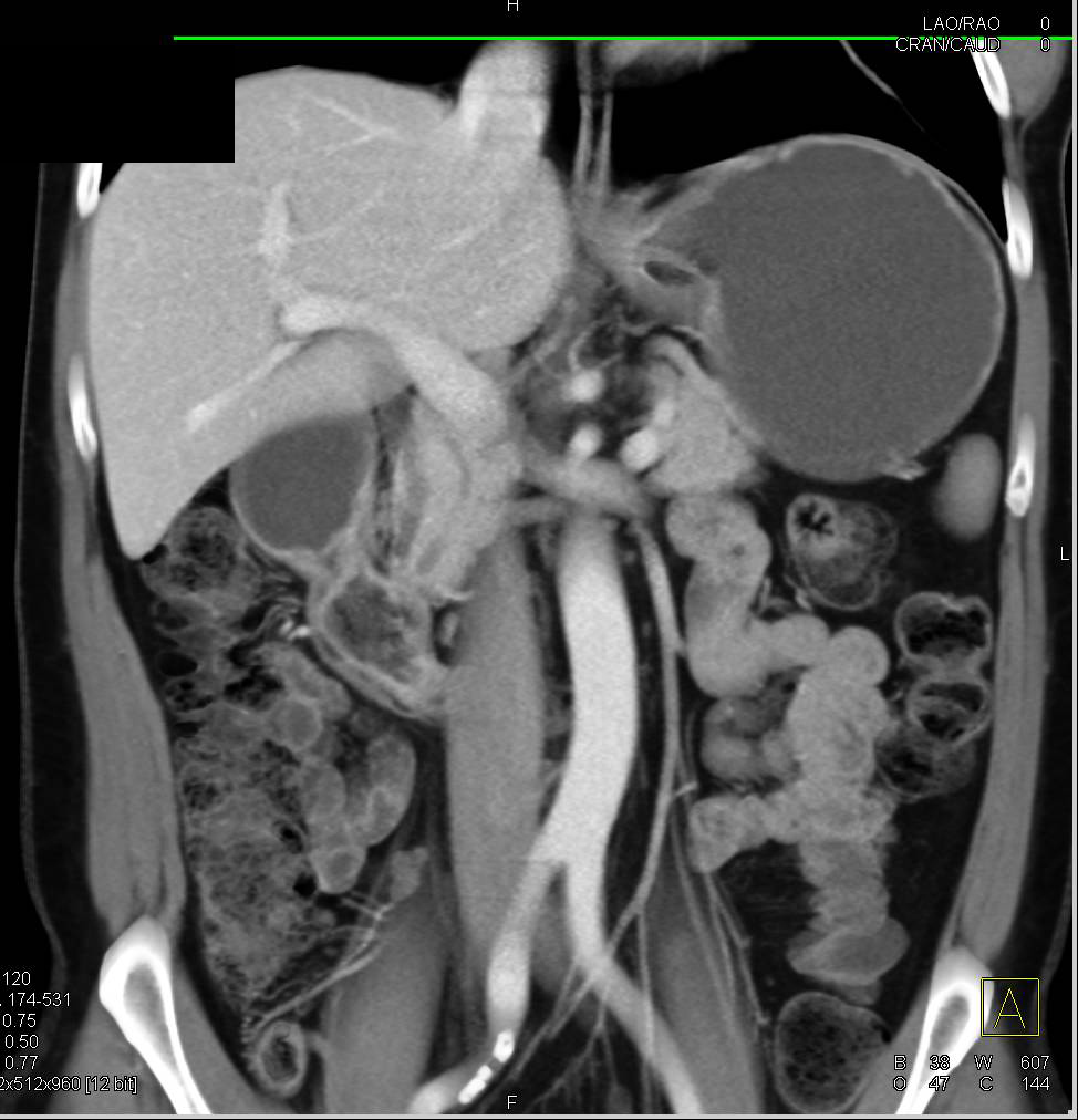 Intraluminal Diverticulum of the Duodenum Simulates a Duodenal Mass - CTisus CT Scan