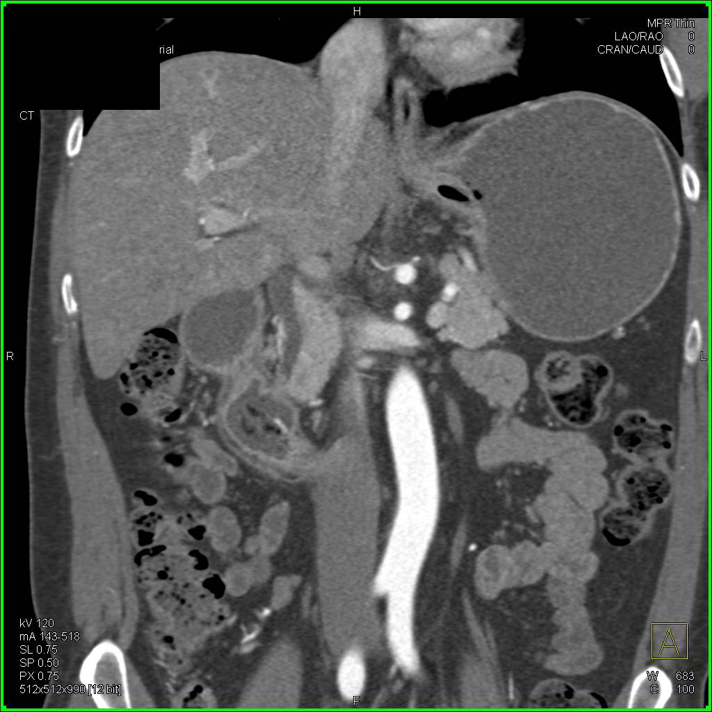 Intraluminal Duodenal Diverticulum Simulates A Duodenal Mass - CTisus CT Scan