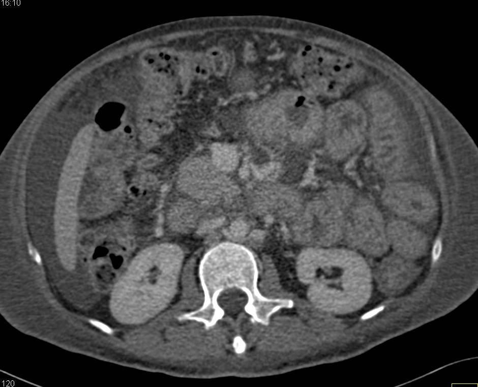 Thickened Small Bowel with Edematous Small Bowel - CTisus CT Scan