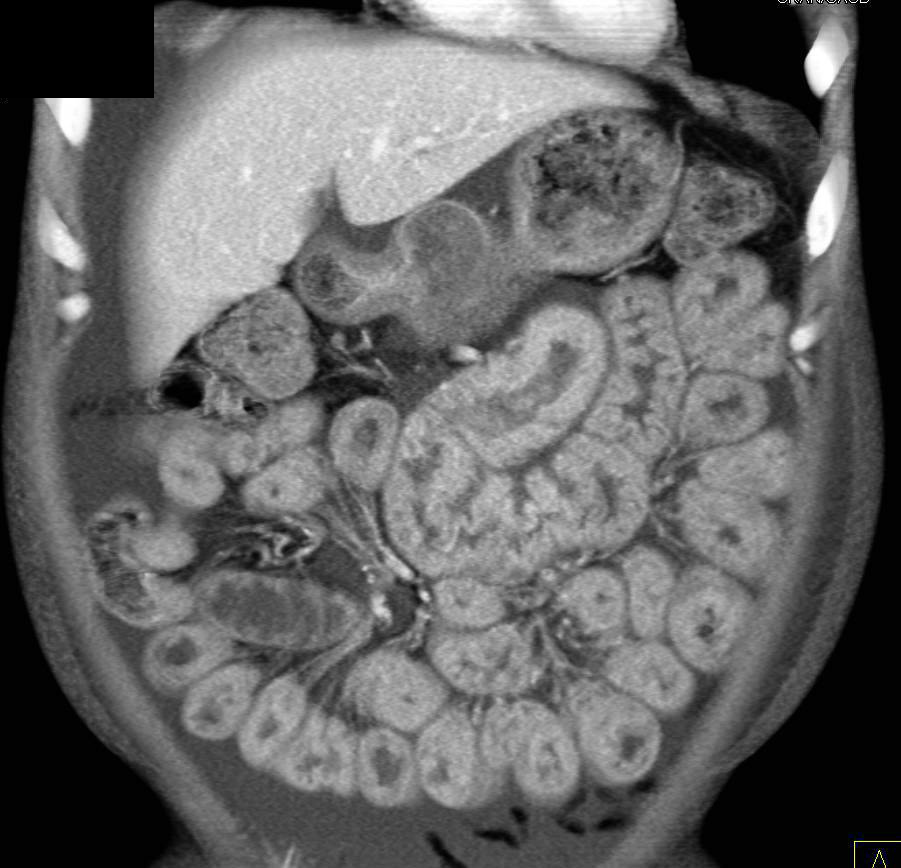 Wet and Thickened Small Bowel due to Sprue - CTisus CT Scan