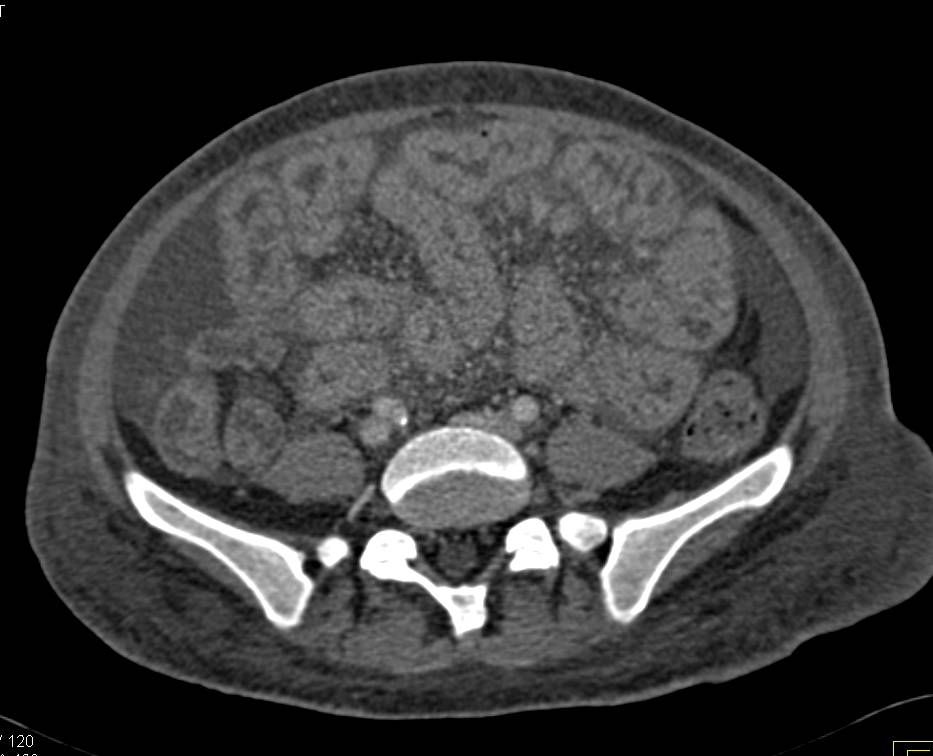 Edematous Small Bowel Due to Sprue - CTisus CT Scan