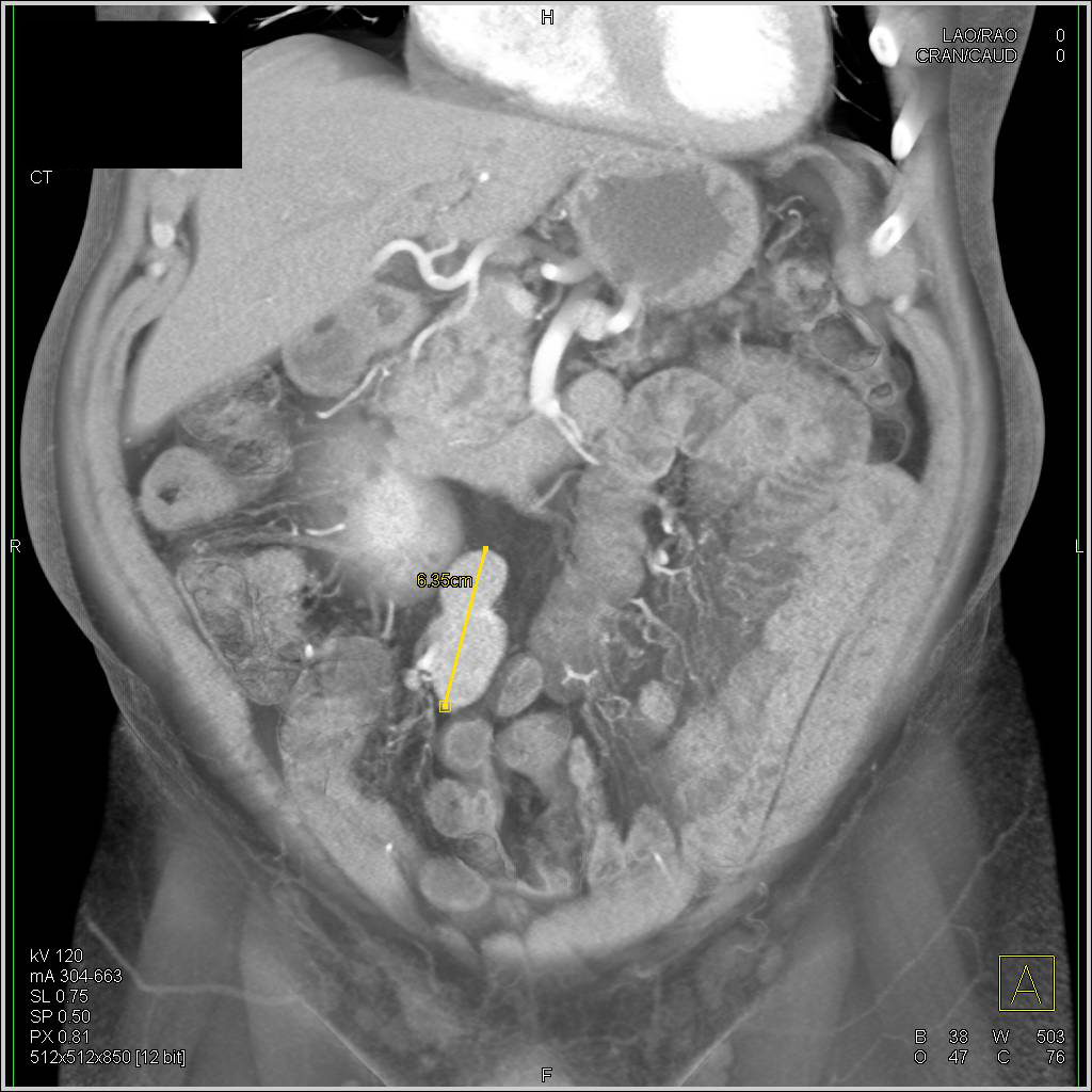 Carcinoid Tumor in the Root of the Mesentery - CTisus CT Scan