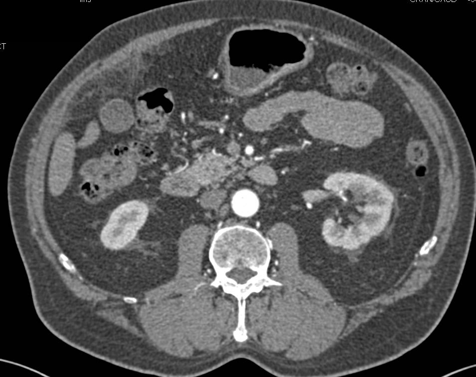 Omental Infarction - CTisus CT Scan