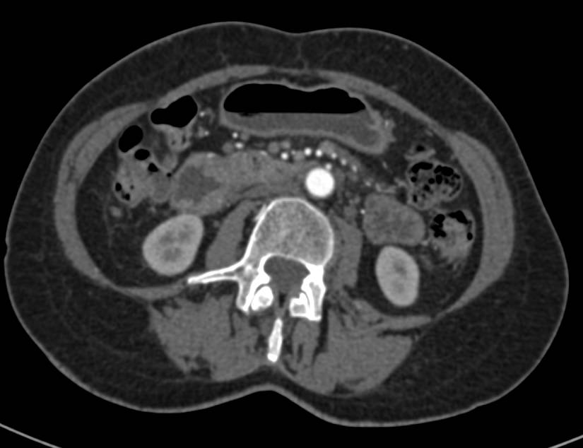 Duodenal Adenocarcinoma with Early Obstruction - CTisus CT Scan