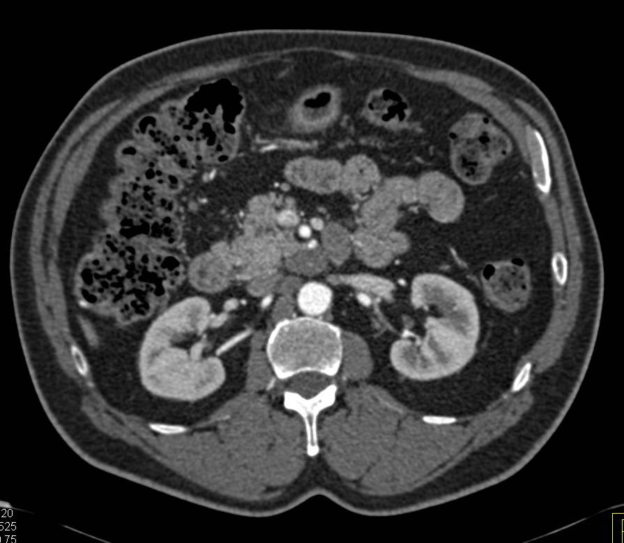 Carcinoid Tumor Extends near the Head of the Pancreas - CTisus CT Scan