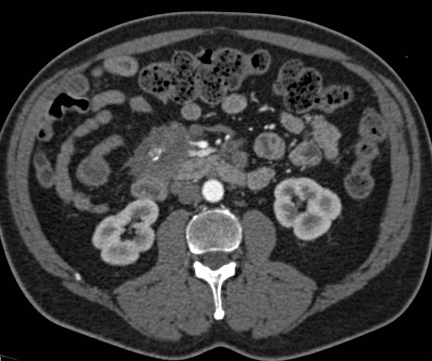 Carcinoid Tumor Simulates a Pancreatic Mass - CTisus CT Scan