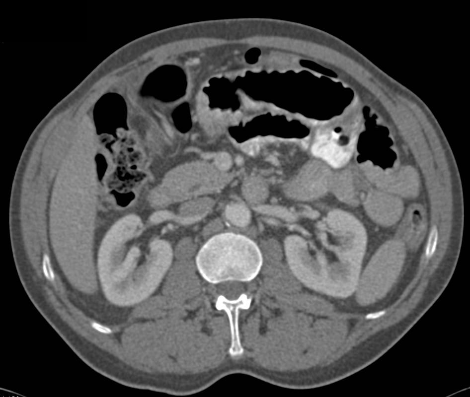 Crohn's Disease Involves Ileum with Mild Small Bowel Obstruction (SBO) - CTisus CT Scan