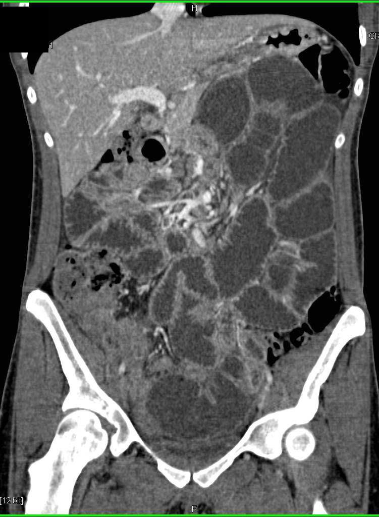 Small Bowel Obstruction due to Adhesions - CTisus CT Scan