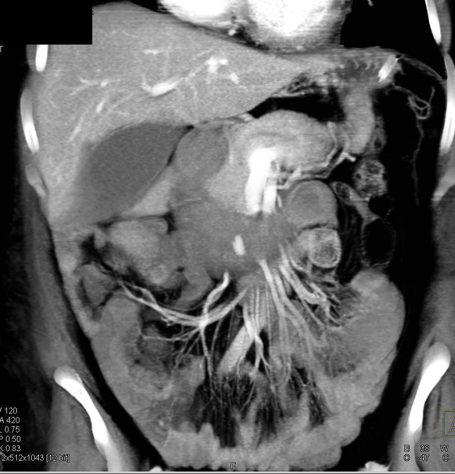 Duodenal Hematoma with Active Bleed - CTisus CT Scan