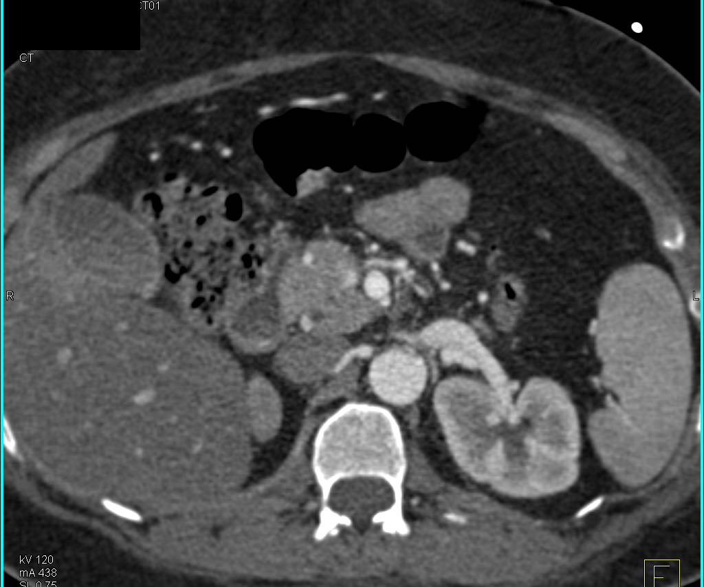 Duodenal Bleed Following Trauma with Active Bleed Seen - CTisus CT Scan