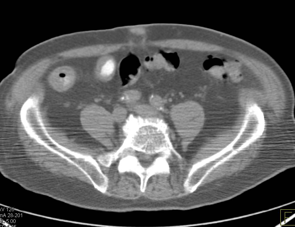 Crohn's Disease involves the Terminal Ileum with PET Correlation - CTisus CT Scan