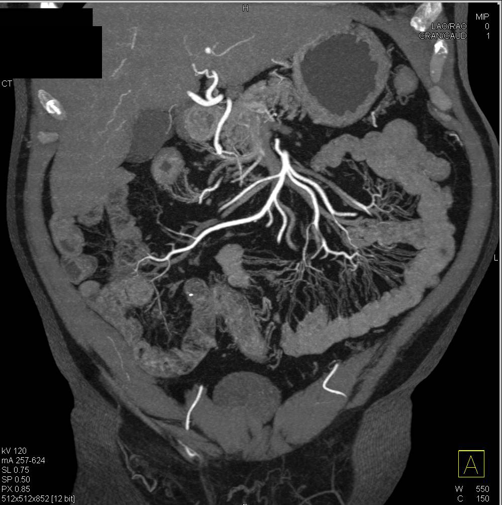 Abnormal Mesenteric Arcade and Thick Small Bowel in Crohn's Disease - CTisus CT Scan