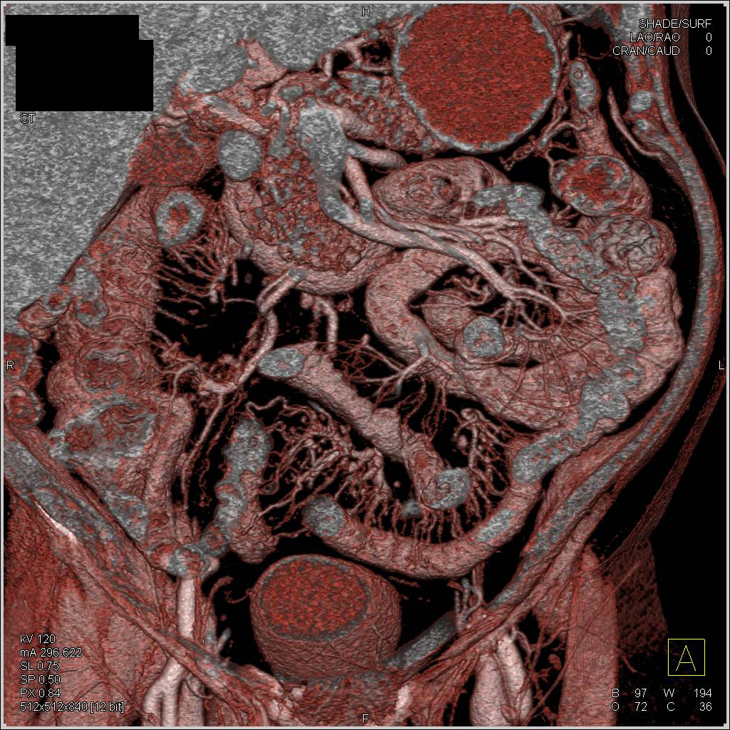 Crohn's Disease with Comb Sign and Thickened Small Bowel - CTisus CT Scan