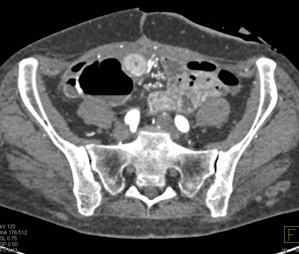 Metastatic Renal Cell Carcinoma to the Pancreas and Small Bowel - CTisus CT Scan