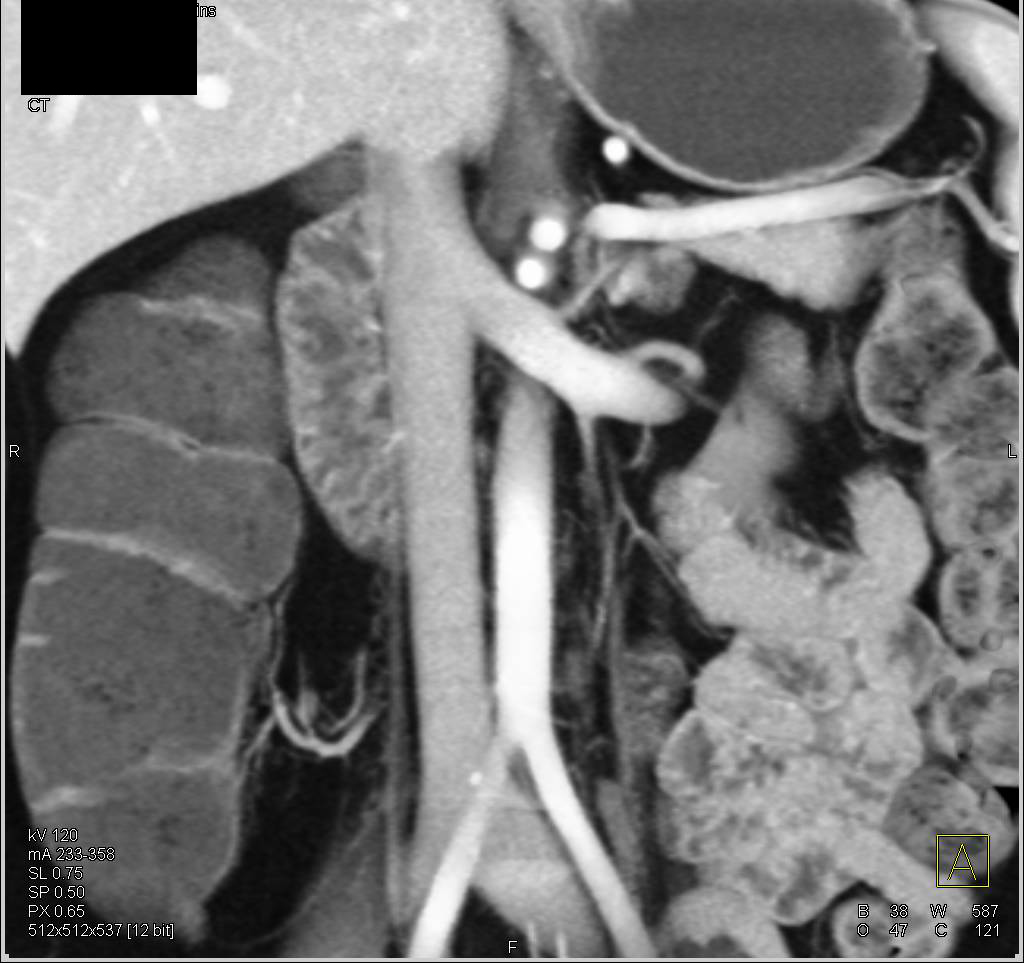 3D of Duodenum - CTisus CT Scan