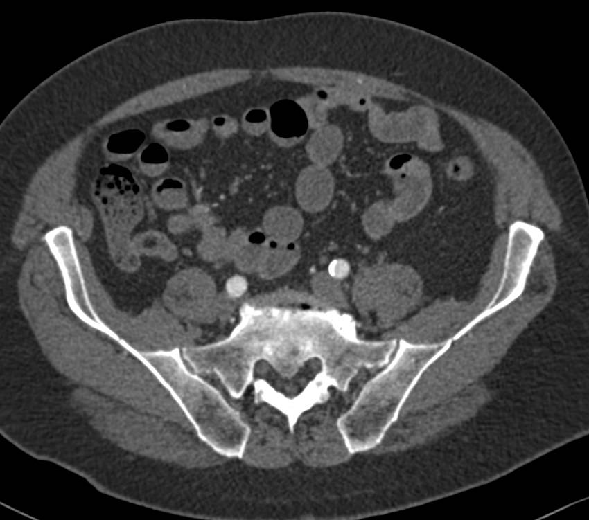 Carcinoid Tumor Right Lower Quadrant Encases the Ileal Artery Branch off the SMA - CTisus CT Scan