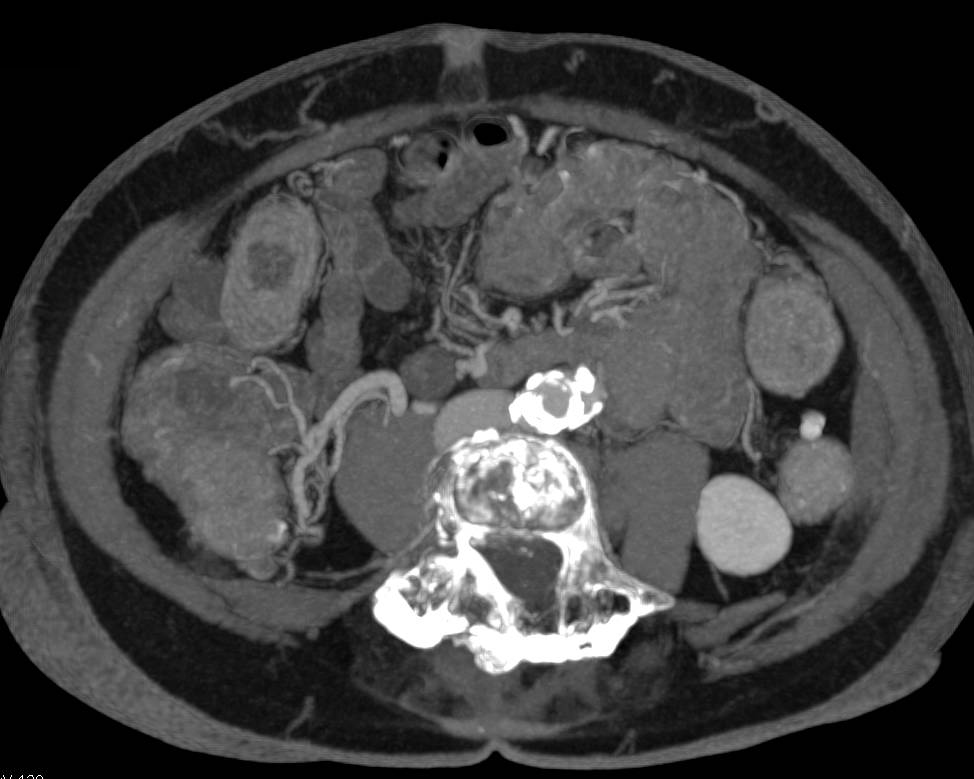 Small Bowel Obstruction due to Crohn's Disease with Feces Sign - CTisus CT Scan