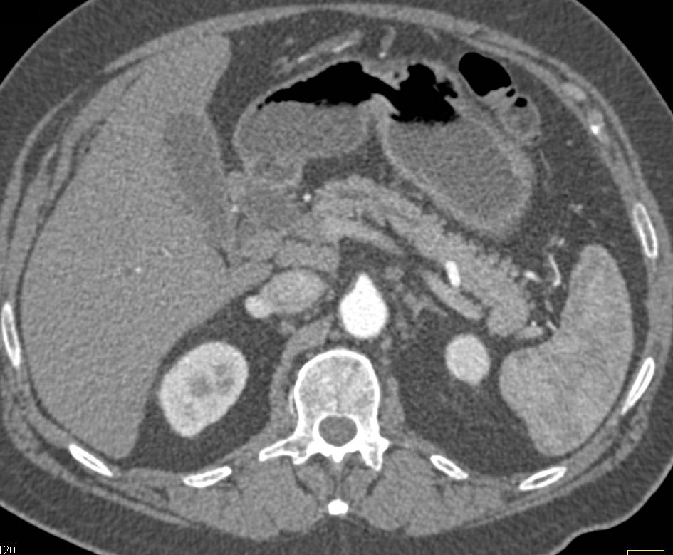 Ampullary Carcinoma Seen Well in 3D - Small Bowel Case Studies - CTisus ...