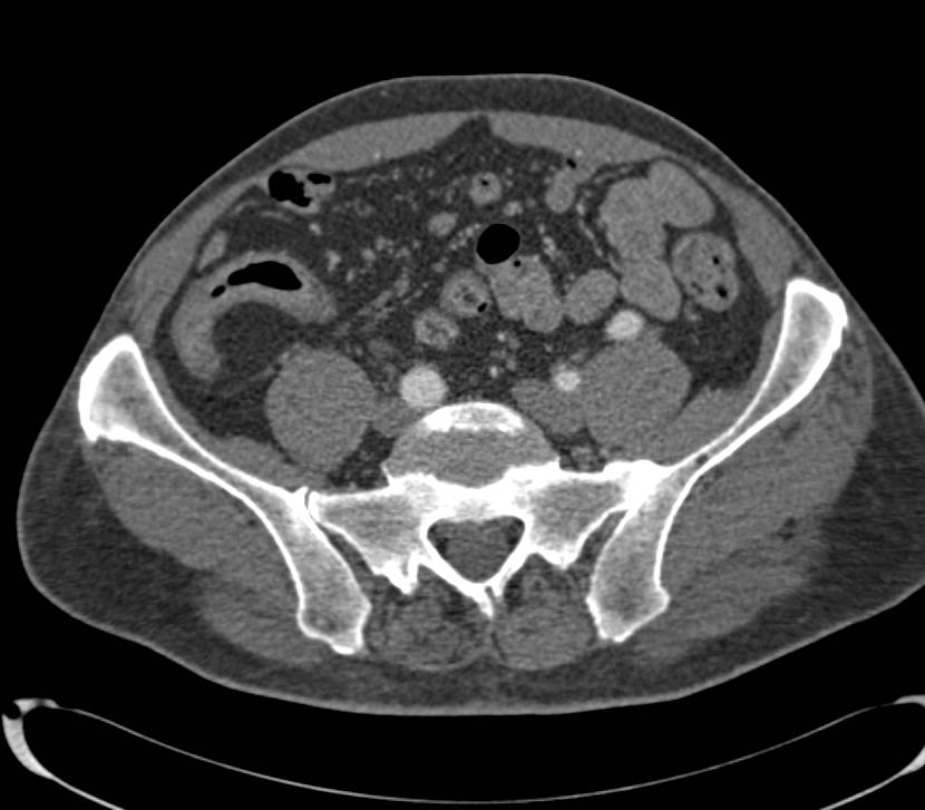 Crohn's Disease with Prominent Vasa Recta - CTisus CT Scan