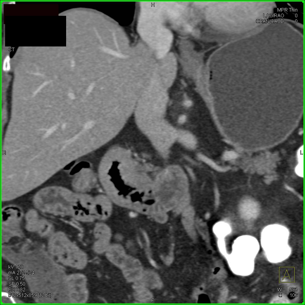 Duodenal Carcinoma - CTisus CT Scan