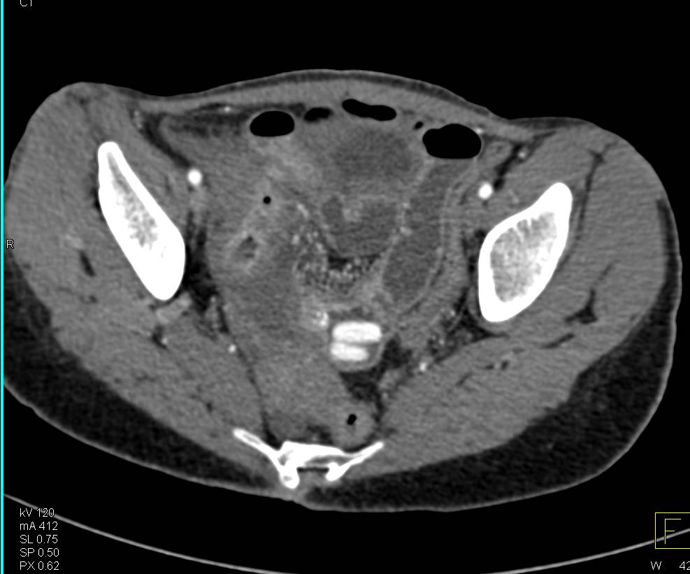 Pills in Thickened Distal Small Bowel due to Crohn's - CTisus CT Scan